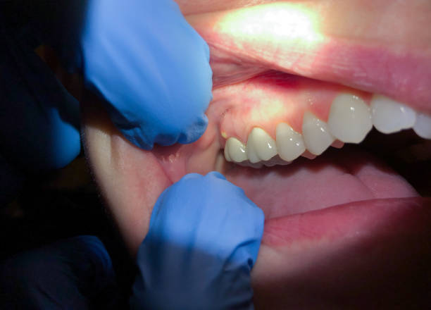 Best Emergency Dental Extractions in Shelby, OH